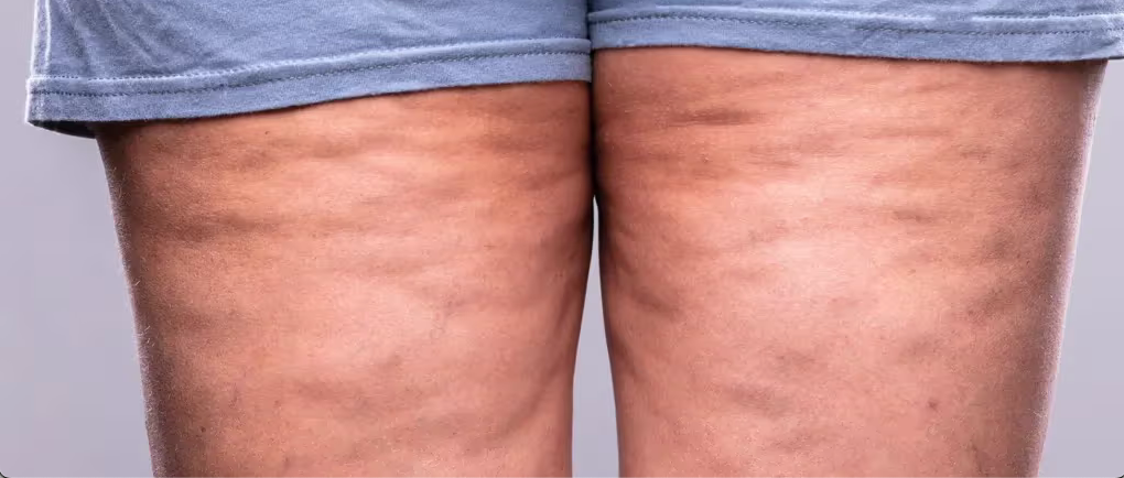 Aspect capitons sur des cuisses avec un legging classique